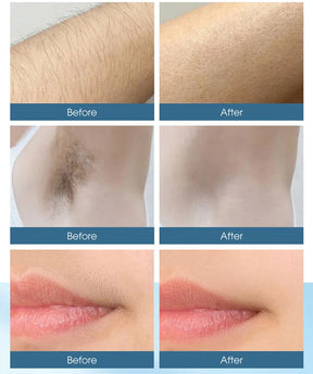 IPL Laser Hair Removal Device